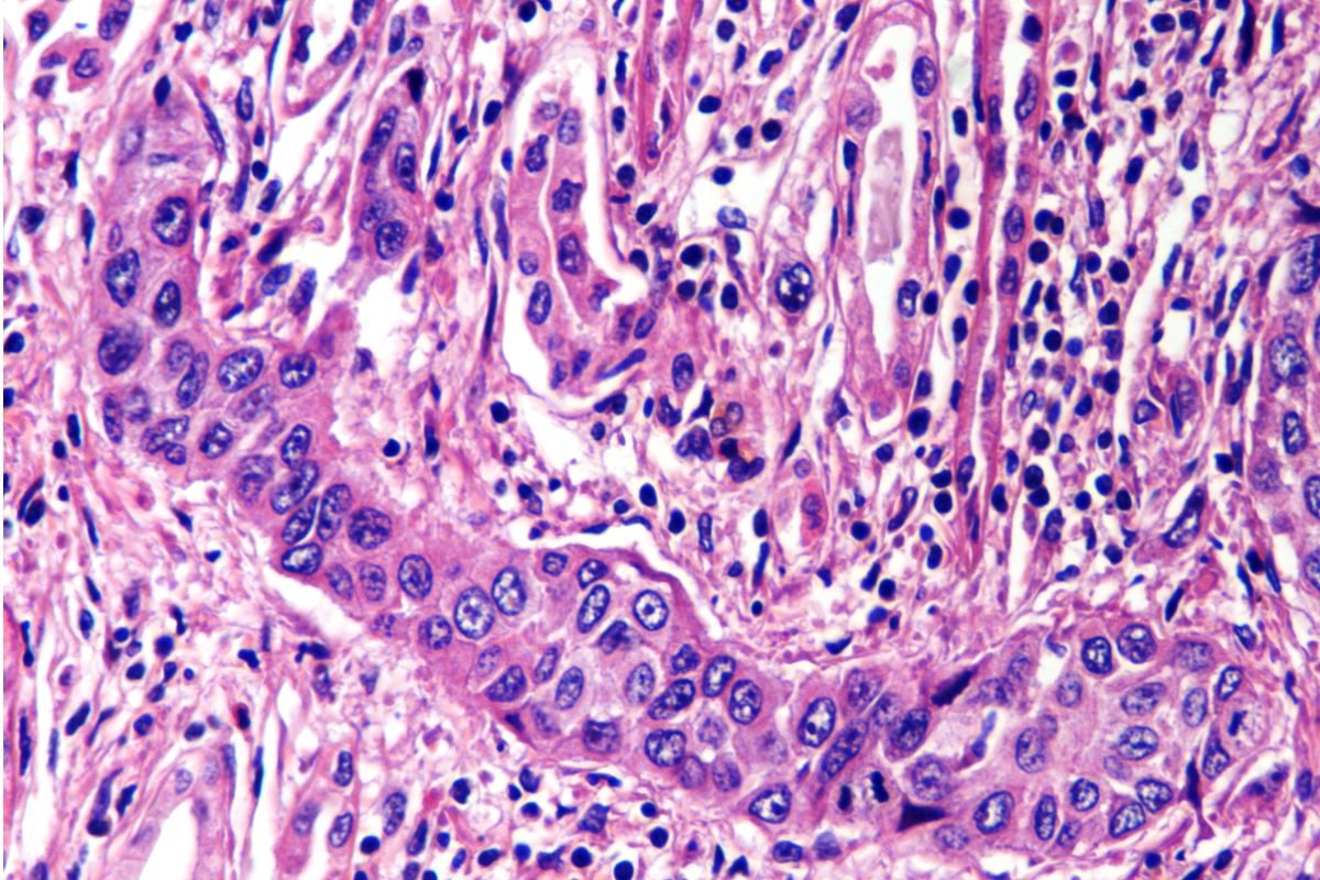 Células de cáncer renal. 